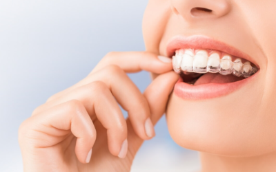 Points You Should Know About Invisalign Treatment