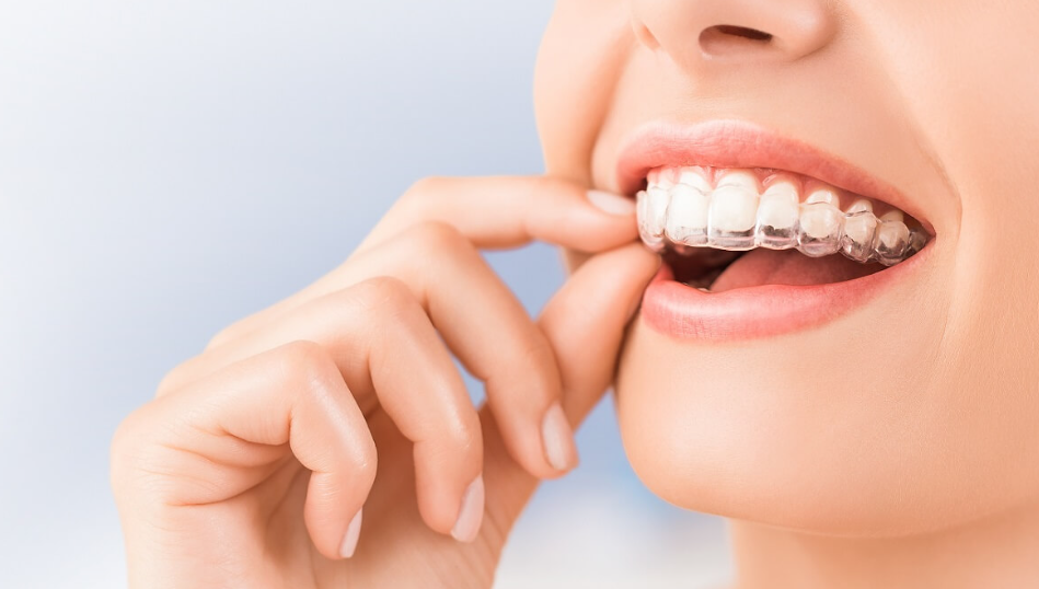 Points You Should Know About Invisalign Treatment